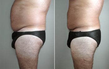 Male Liposuction Patient 26