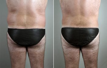 Male Liposuction Patient 26