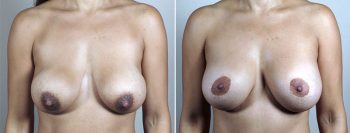 Mommy Makeover Patient 26