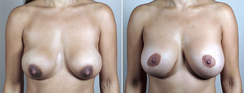 Mommy Makeover Patient 26