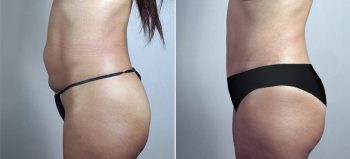 Mommy Makeover Patient 26