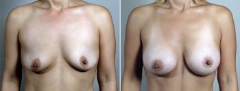 Mommy Makeover Patient 27