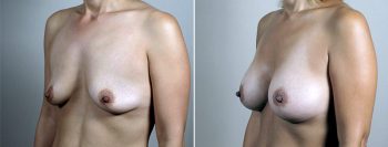 Mommy Makeover Patient 27