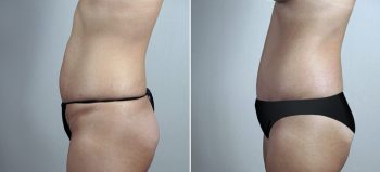 Mommy Makeover Patient 27