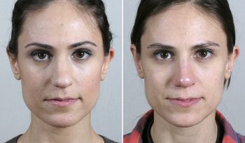 Rhinoplasty Patient 59