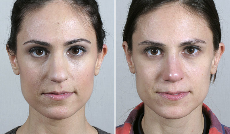 Rhinoplasty Patient 59