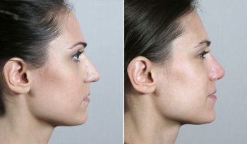 Rhinoplasty Patient 59