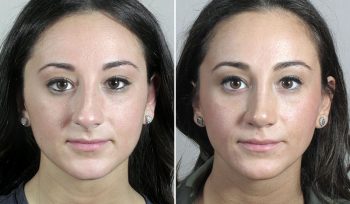 Rhinoplasty Patient 61