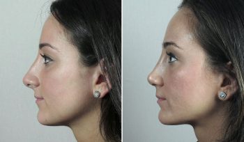 Rhinoplasty Patient 61