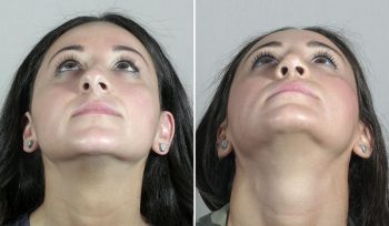 Rhinoplasty Patient 61