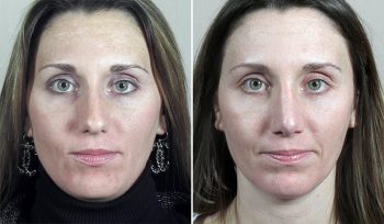 Rhinoplasty Patient 55