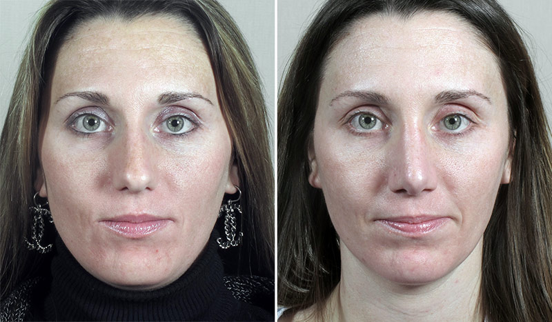 Rhinoplasty Patient 55