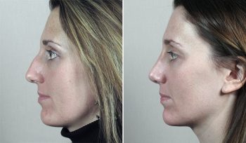 Rhinoplasty Patient 55