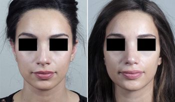 Rhinoplasty Patient 56