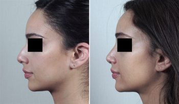 Rhinoplasty Patient 56