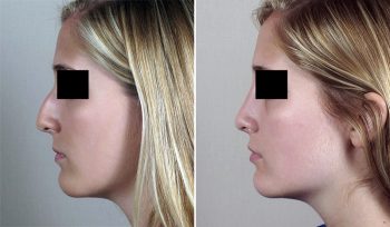 Rhinoplasty Patient 57