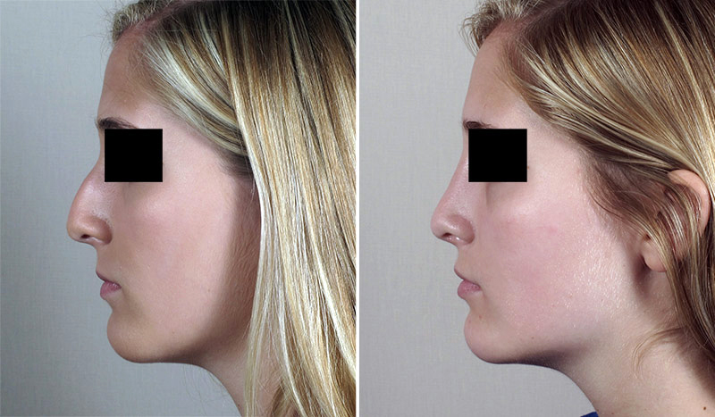 Rhinoplasty Patient 57