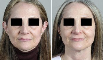 Rhinoplasty Patient 58