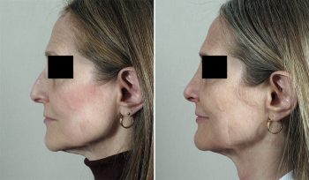 Rhinoplasty Patient 58