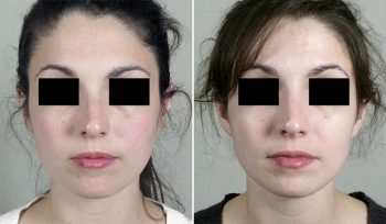 Rhinoplasty Patient 60