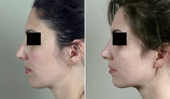 Rhinoplasty Patient 60