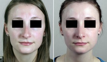 Rhinoplasty Patient 62