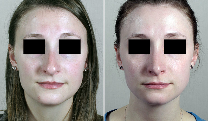 Rhinoplasty Patient 62