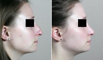 Rhinoplasty Patient 62