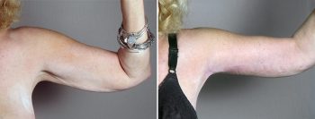 Upper Arm Rejuvenation Patient 14 – Arm Lift
