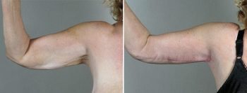 Upper Arm Rejuvenation Patient 14 – Arm Lift