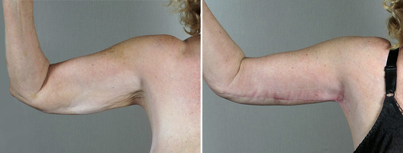 Upper Arm Rejuvenation Patient 14 – Arm Lift
