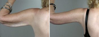 Upper Arm Rejuvenation Patient 14 – Arm Lift