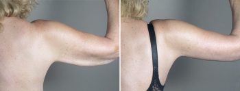 Upper Arm Rejuvenation Patient 14 – Arm Lift