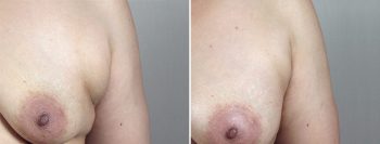 Breast Enlargement (Augmentation) Patient 86