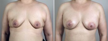 Breast Enlargement (Augmentation) Patient 86