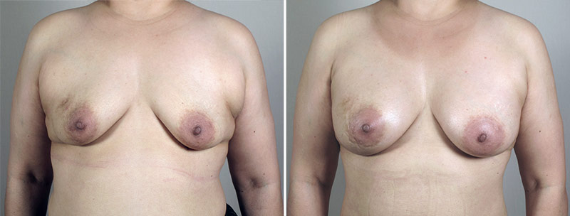 Breast Enlargement (Augmentation) Patient 86