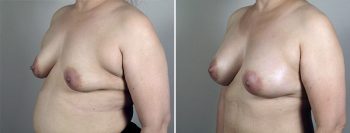 Breast Enlargement (Augmentation) Patient 86