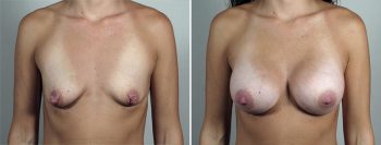 Breast Enlargement (Augmentation) Patient 87