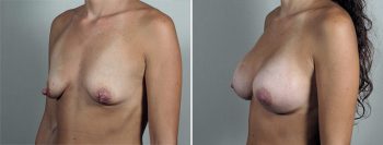 Breast Enlargement (Augmentation) Patient 87