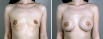 Breast Enlargement (Augmentation) Patient 88