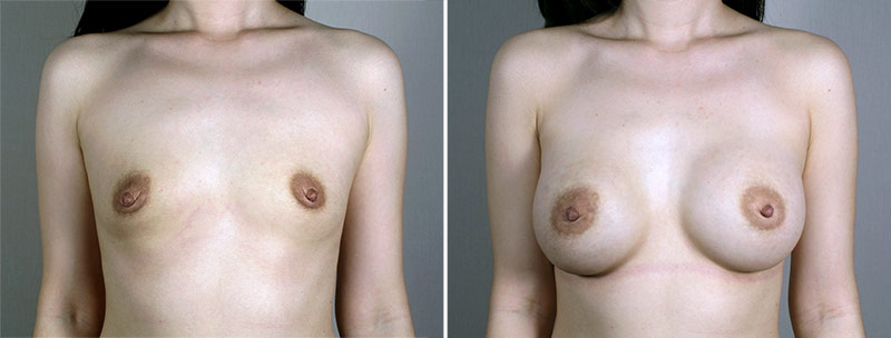 Breast Enlargement (Augmentation) Patient 88
