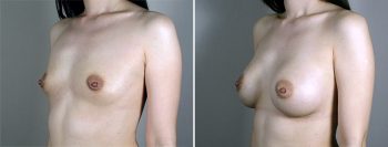 Breast Enlargement (Augmentation) Patient 88