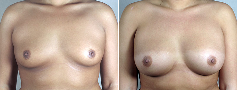 Breast Enlargement (Augmentation) Patient 89