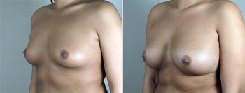 Breast Enlargement (Augmentation) Patient 89