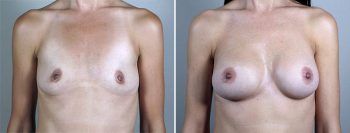 Breast Enlargement (Augmentation) Patient 90