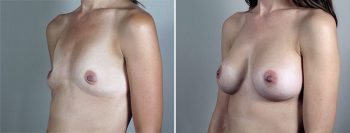 Breast Enlargement (Augmentation) Patient 90