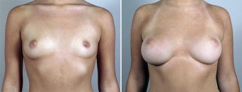 Breast Enlargement (Augmentation) Patient 91