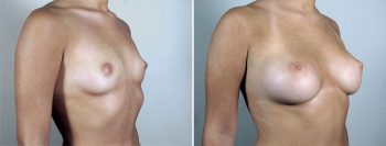 Breast Enlargement (Augmentation) Patient 91