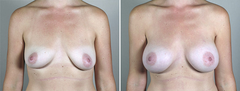 Breast Enlargement (Augmentation) Patient 92