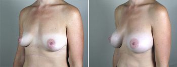 Breast Enlargement (Augmentation) Patient 92